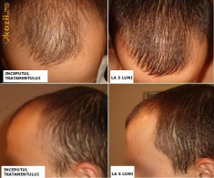 Tratament impotriva caderii parului, cheliei, alopeciei avansate kirklandminoxidil5.tk foto