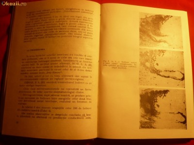 &amp;#039;&amp;#039;BOALA PILONIDALA&amp;#039;&amp;#039; de PETRU MARTIN foto