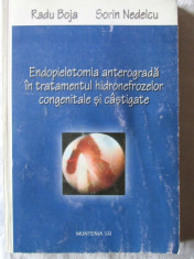 &amp;quot;ENDOPIELOTOMIA ANTEROGRADA IN TRATAMENTUL HIDRONEFROZELOR CONGENITALE SI CASTIGATE&amp;quot;, Radu Boja / Sorin Nedelcu, 2003. Endourologie. Carte noua foto