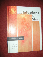 Atlas dermato venerologie - Atlas of infection of the skin - Anthony du Vivier foto