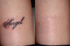 Indepartare Stergere Tatuaje, Craiova! foto