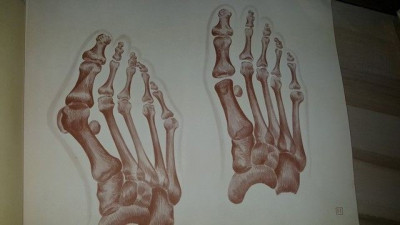 Hygroma de la face interne de la tete du l metatarsien sur hallux valgus foto