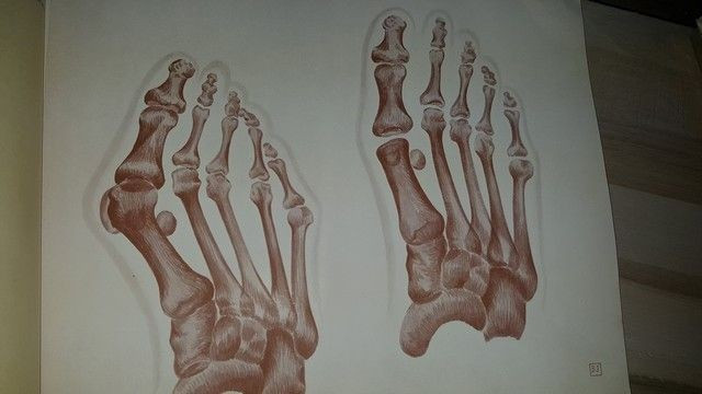 Hygroma de la face interne de la tete du l metatarsien sur hallux valgus