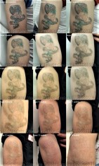 Indepartare Stergere Tatuaje Craiova cu Laser American PicoWay foto