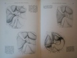 CHIRURGIA CAILOR BILIARE EXTRAHEPATICE de I. TURAI, D. GEROTA 1957