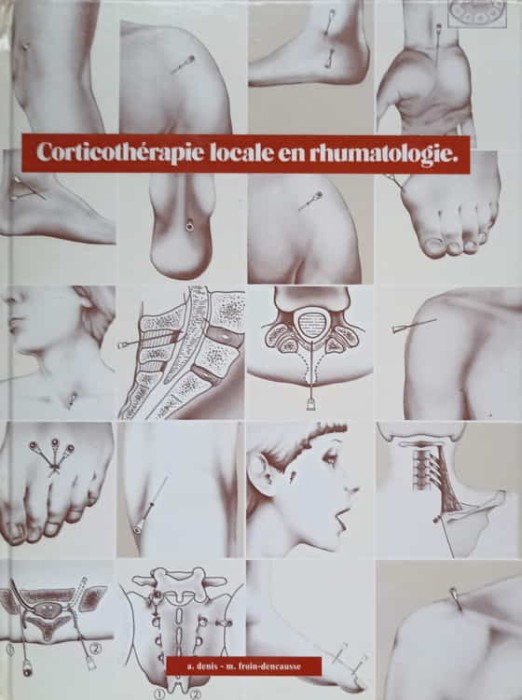 CORTICOTHERAPIE LOCALE EN RHUMATOLOGIE-A. DENIS -236051