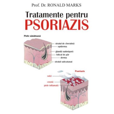 Tratamente pentru psoriazis - Prof. dr. Ronald Marks foto