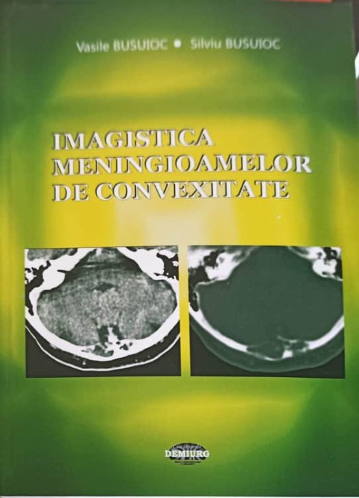 IMAGISTICA MENINGIOAMELOR DE CONVEXITATE-VASILE BUSUIOC, SILVIU BUSUIOC-254803