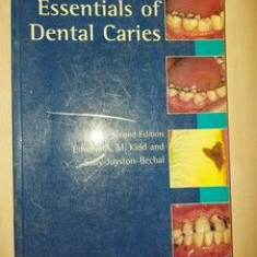 Essentials of dental caries