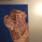 Head and neck cancer,Eric m genden, 0184