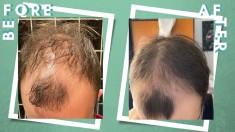 Minoxidil Dualgen 10% + Minoxidil Kirkland 5%, 2 luni aplicare, Tratament par foto
