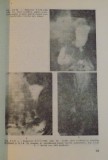 SUFERINTELE TARDIVE CONSECUTIVE CHIRURGIEI ULCERULUI GASTRO-DUODENAL , 1990