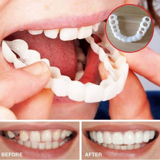 Fatete dentare Snap On Smile acopera orice imperfectiuni fara dentist Fatete dentare Snap On Smile acopera orice imperfectiuni fara dentist