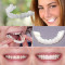 Fatete dentare Snap On Smile solutia ideala pentru un zambet perfect proteza