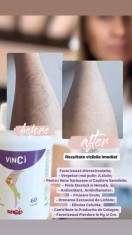 Vinci pt varice,celulita, hemoroizi, vene varicoase, picioare grele foto