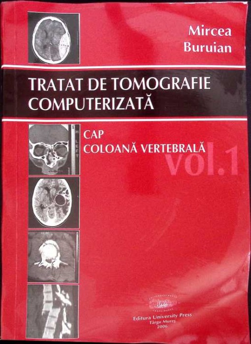 TRATAT DE TOMOGRAFIE COMPUTERIZATA VOL.1 CAP, COLOANA VERTEBRALA-MIRCEA BURUIAN-262407