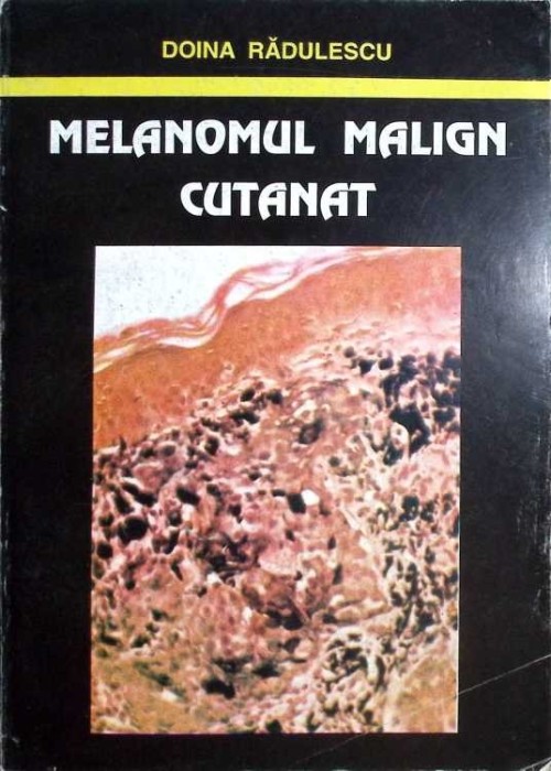 MELANOMUL MALIGN CUTANAT-DOINA RADULESCU-263856