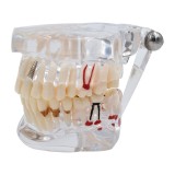 Model Dentar Educational, Zamo&reg;, Utilizat pentru Exemplificarea Patologiilor Dentare, 31 dinti, material Acrilat, Transparent