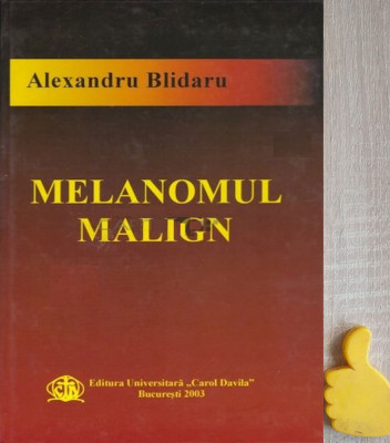 Melanomul malign Alexandru Blidaru foto