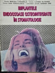 Implantele endoosoase osteointegrate in stomatologie - Mihai Augustin